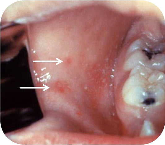 Blickdiagnose: Koplik-Flecken (Masern) 👁️