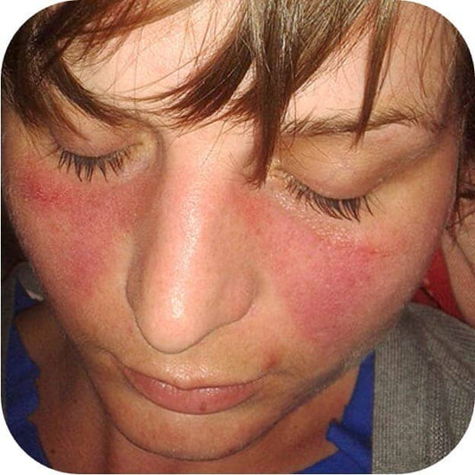 Blickdiagnose Schmetterlingserythem (Lupus erythematodes) 🦋
