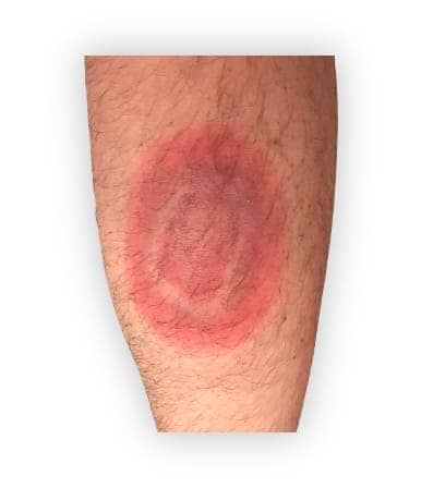 Blickdiagnse: Erythema migrans (im Rahmen einer Lyme-Borreliose) 👁️