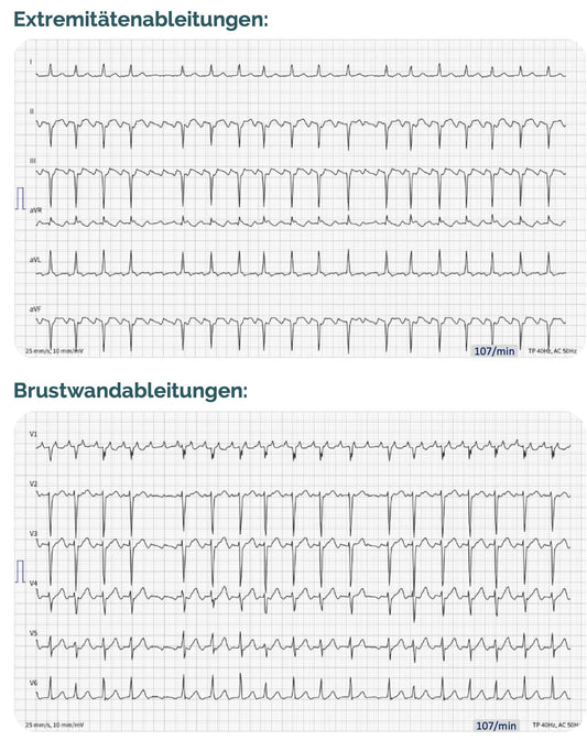 EKG Fallbeispiel: kommst du auf die Diagnose? 🫀