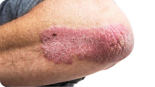 Blickdiagnose: Psoriasis vulgaris 👁️