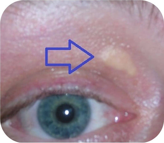 Blickdiagnose-Quiz: Xanthelasma 👁️