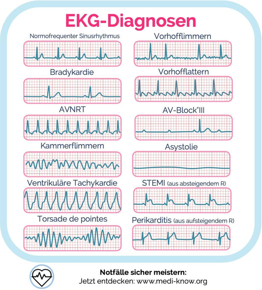 Die 12 wichtigsten EKG-Diagnosen auf einen Blick 🧠