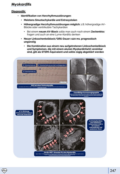 Myokarditis MRT